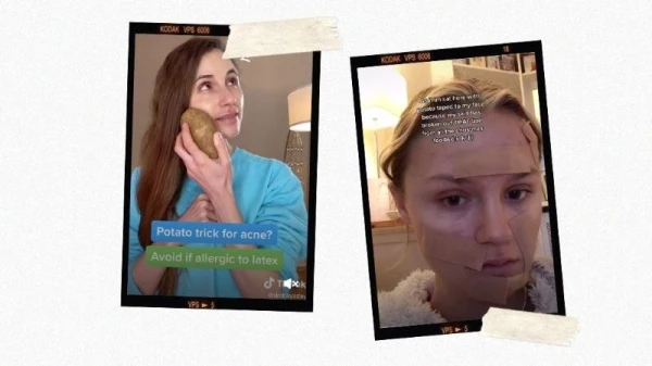حيلة جمالية جديدة على تيك توك: تطبيق البطاطس على الوجه لمعالجة حب الشباب... فهل هي مفيدة؟