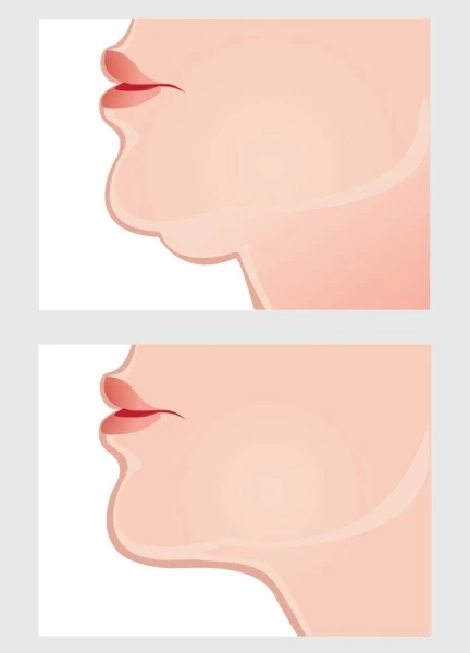 اسألي جمالكِ: كيف أتخلّص من الذقن المزدوج؟