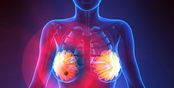 3 طرق لتفادي إصابتكِ بسرطان الثدي من جديد