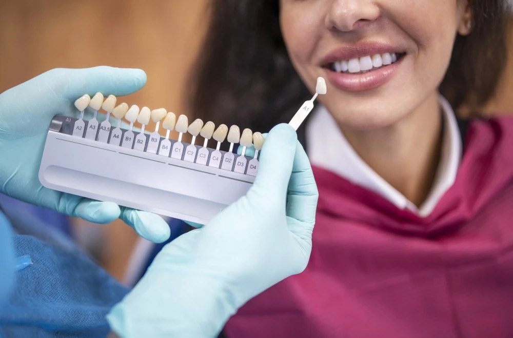ما هو فينير الاسنان وكيف يمنحكِ ابتسامة جميلة؟ هنا دليل كامل عنه