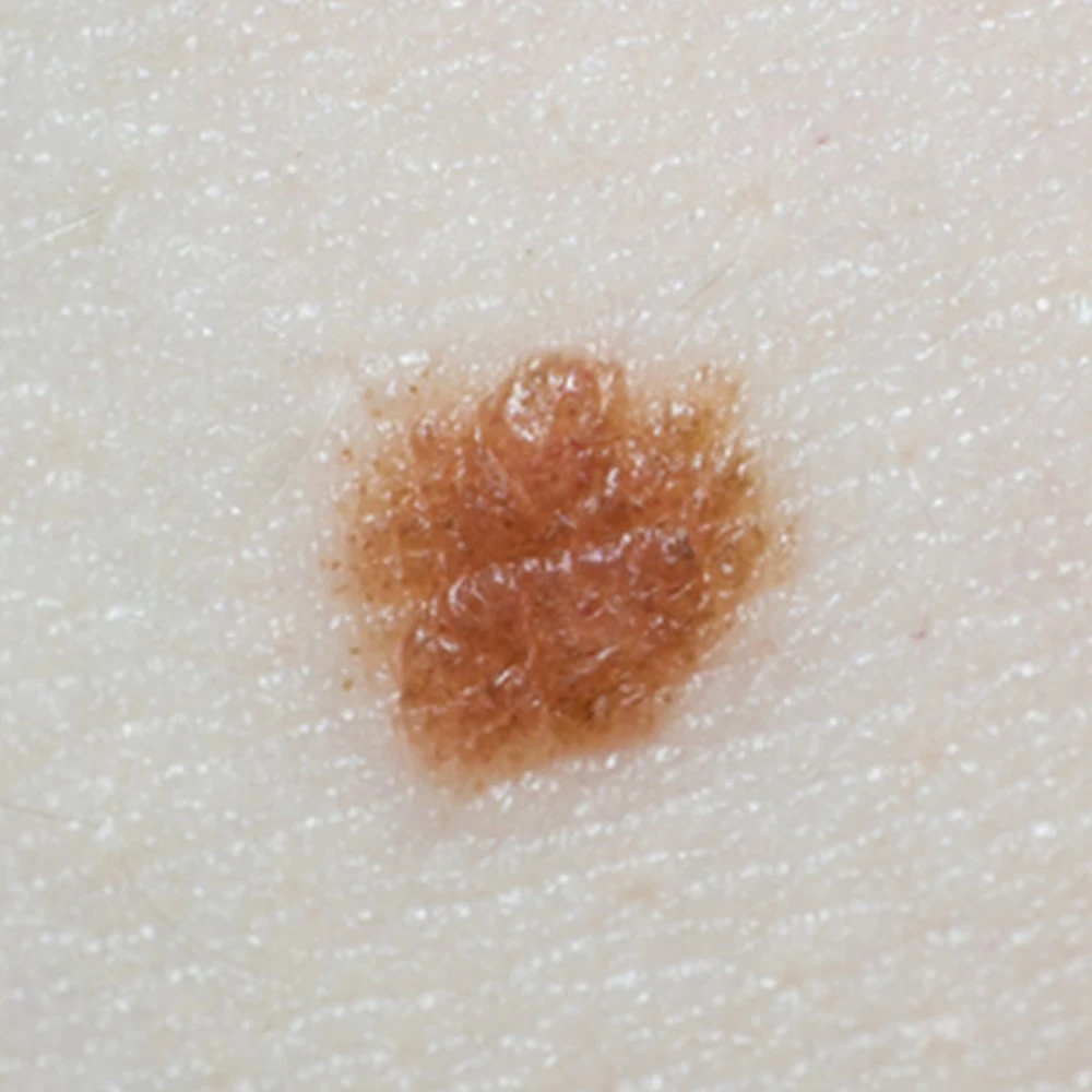 سرطان الجلد اعراض سرطان الجلد