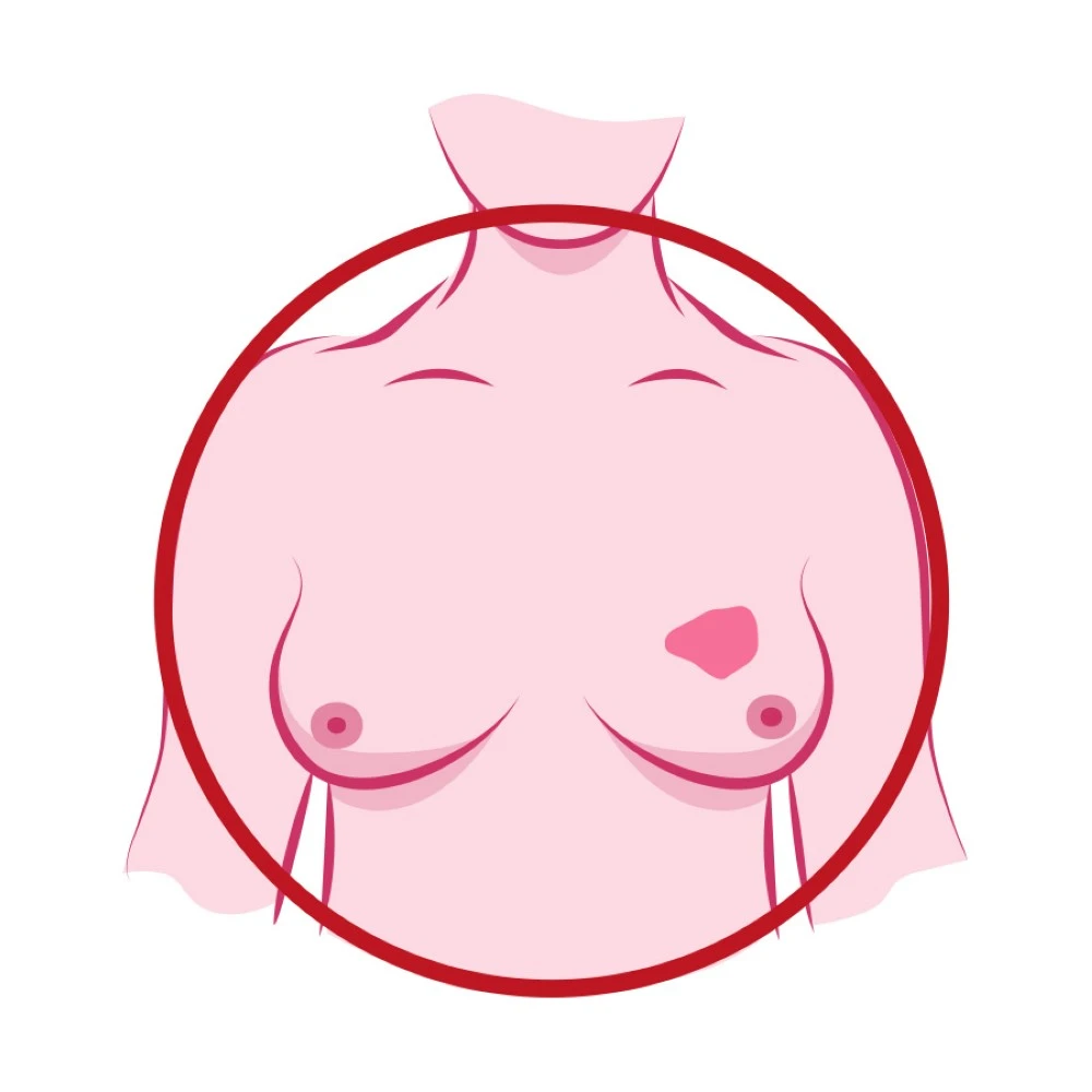 ما هو سرطان الثدي الالتهابي اعراض سرطان الثدي الالتهابي ما هي اسباب سرطان الثدي الالتهابي