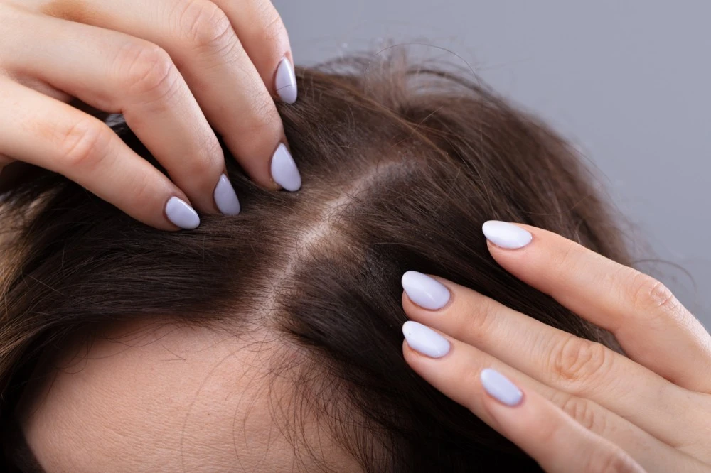 كل ما عليكِ معرفته عن اكزيما الشعر وطرق علاجها