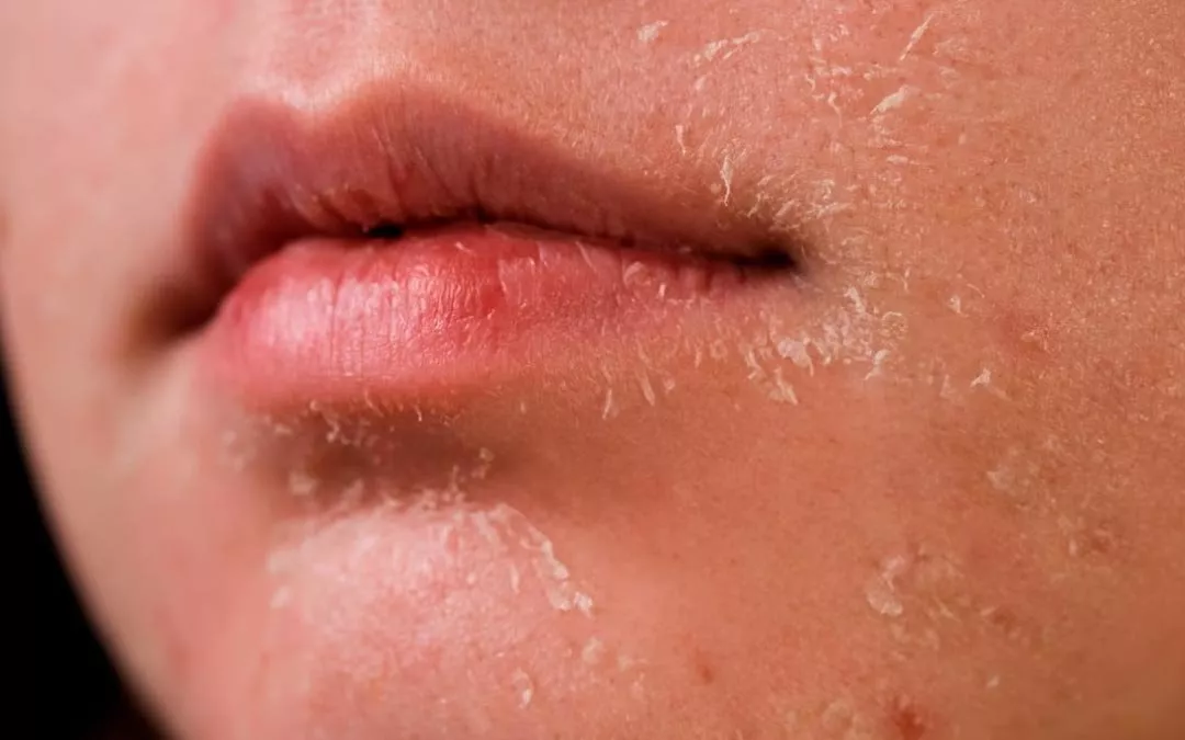 حبوب الوجه، التصبغات، الجفاف... 5 مشاكل بشرة قد تواجهينها في عمر العشرين