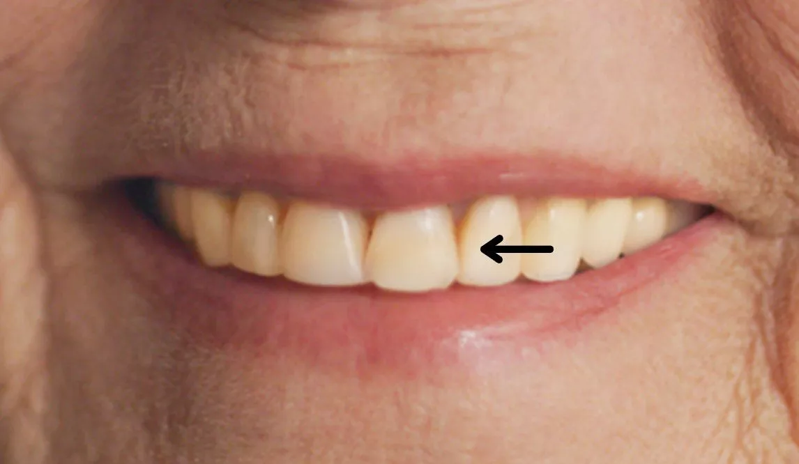 هل الاسنان تتغير مع العمر، وماذا عن الابتسامة ككلّ؟