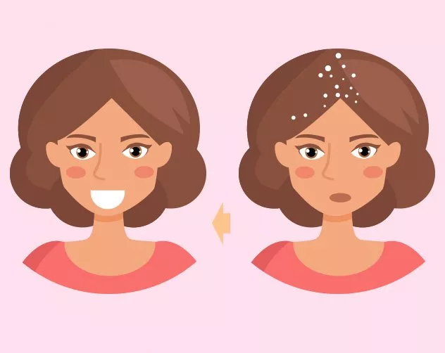 دليلكِ الكامل حول قشرة الشعر: أسباب ظهورها وكيفية التخلّص منها بـ3 مراحل