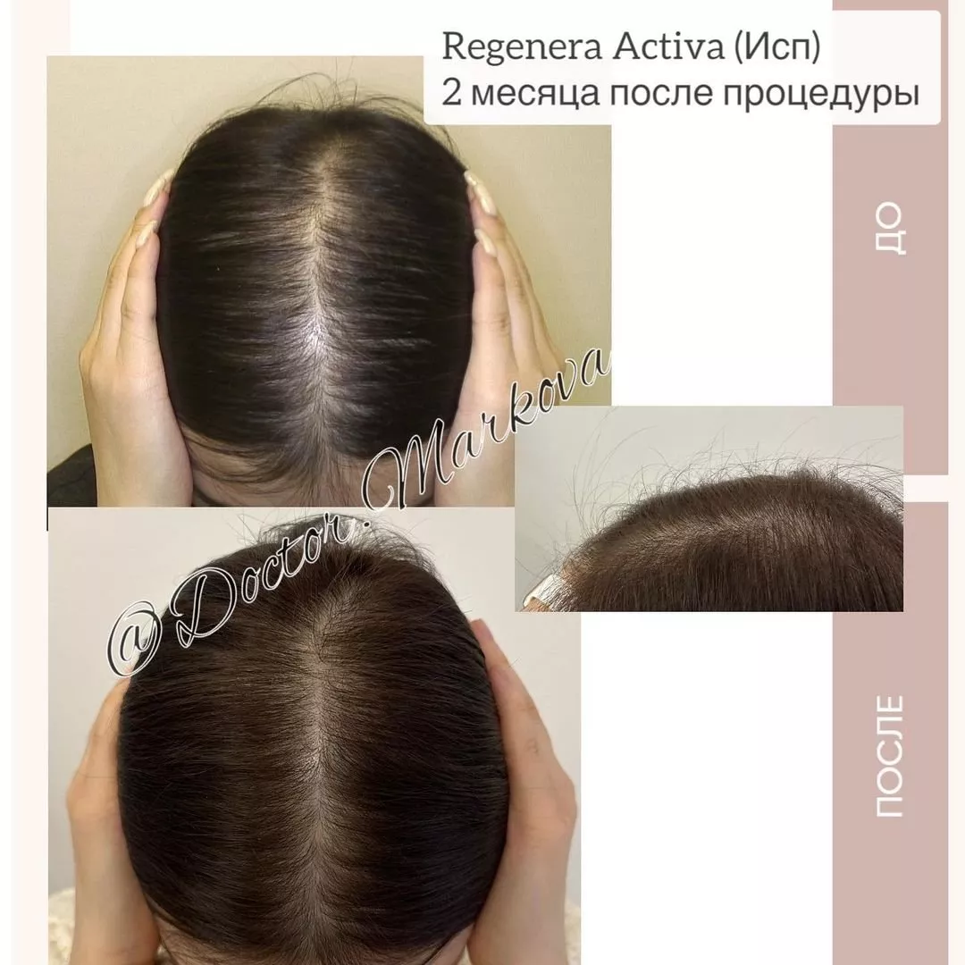 Regenera Activa: تقنية جديدة تعد بعلاج تساقط الشعر من دون جراحة
