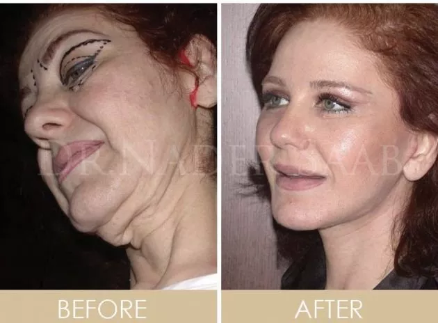 صور ميادة الحناوي قبل وبعد عملية التجميل تثير الجدل