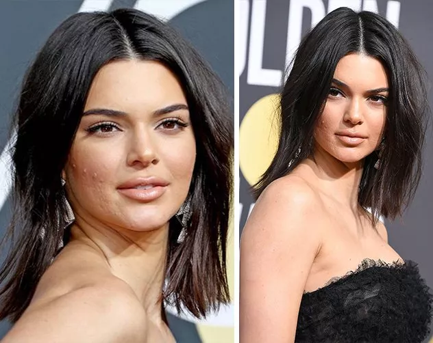 بشرة Kendall Jenner وشفاهها المنتفخة في Golden Globes 2018 تثيران الجدل