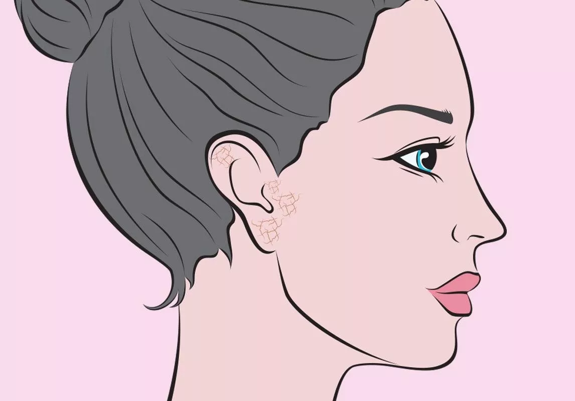 جفاف بشرة الأذن: أسبابها، علاقتها بشيخوخة الوجه وطرق علاجها