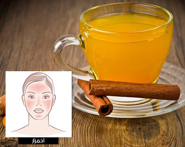 احمرار البشرة 