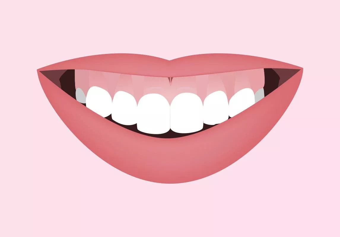 الابتسامة اللثوية: شكلها، أسبابها و6 علاجات للتخلّص منها