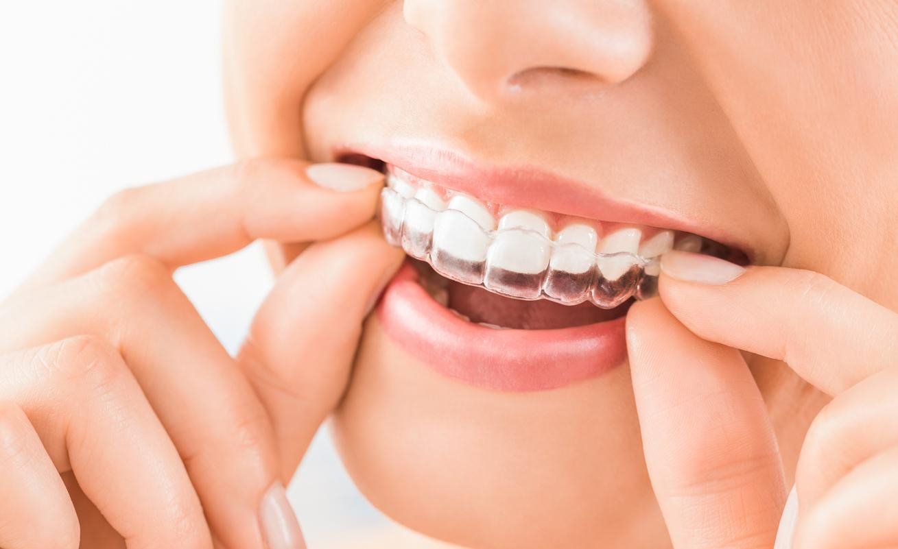 قوالب تبييض الاسنان العناية بالاسنان