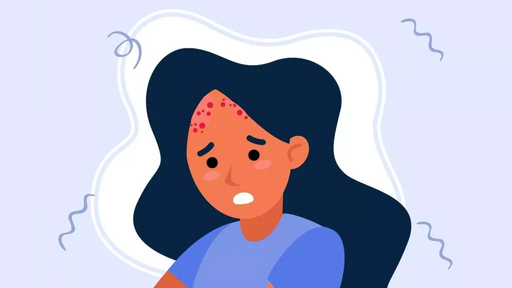 لنتحدّث عن اكزيما الشعر... هذه هي أسبابها وطرق علاجها